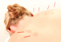 Acupuncture Eases Hot Flashes